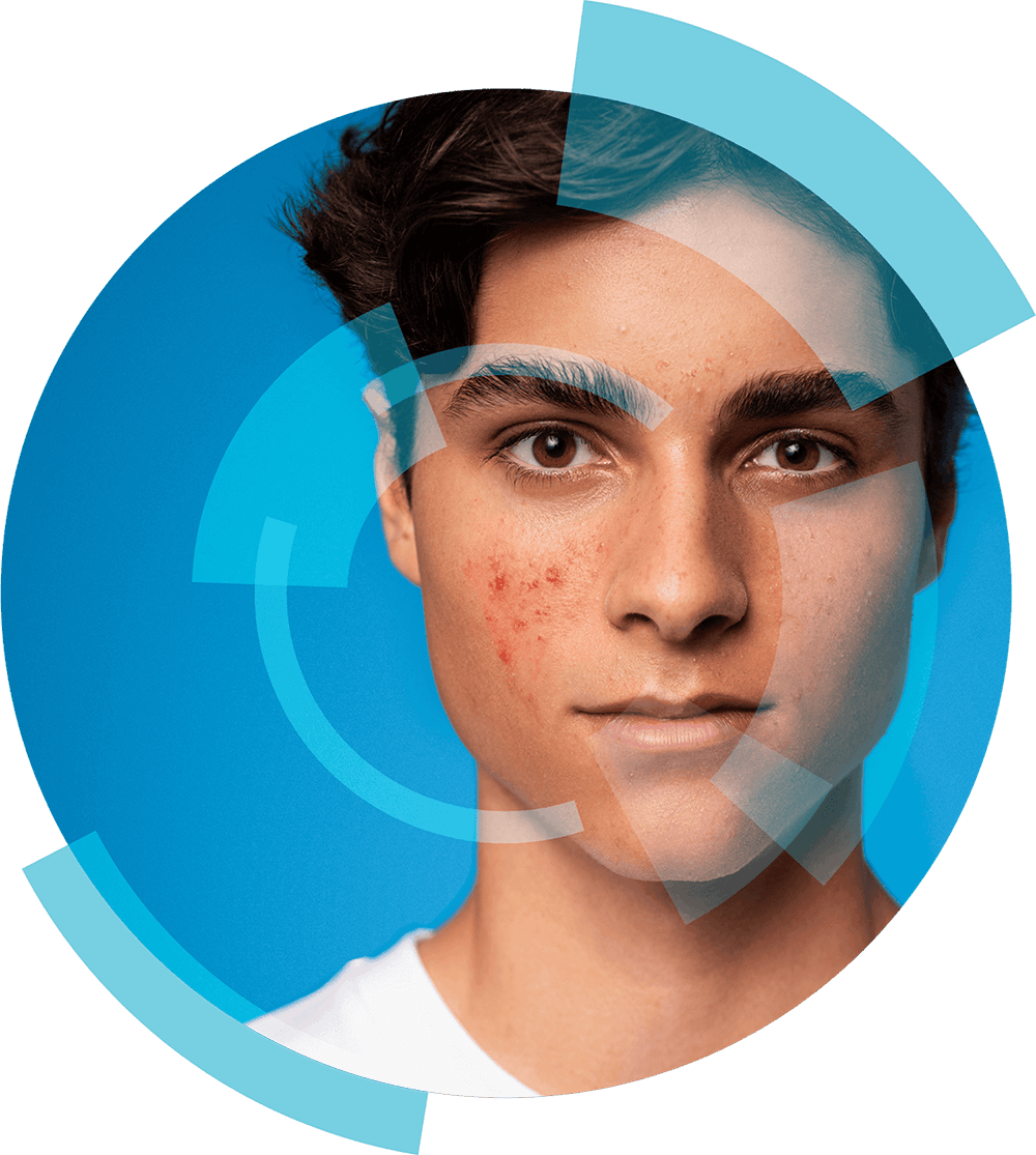Winlevi patient 2